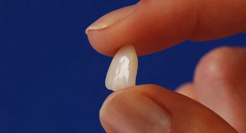 Bloco Dentário de Porcelana em Curitiba - Odontologia Curitiba