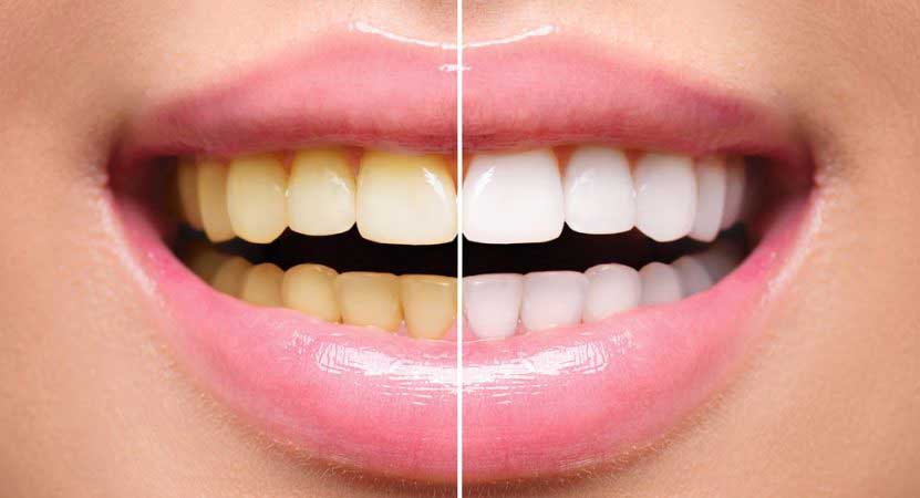 Clareamento dental em curitiba - Odontologia Curitiba