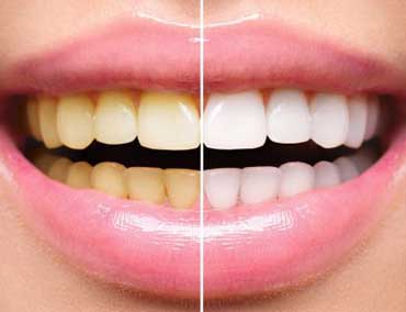 Clareamento dos dentes em Curitiba - Odontologia Curitiba