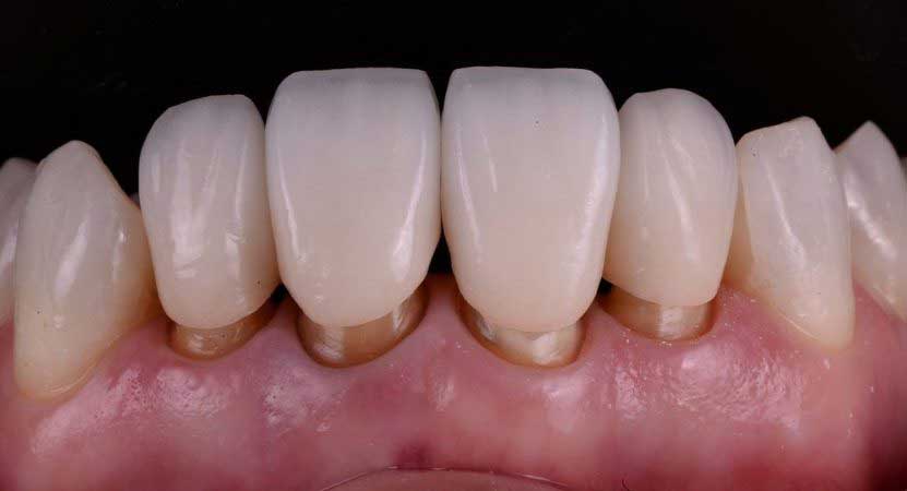 Coroa de porcelana em Curitiba - Odontologia Curitiba