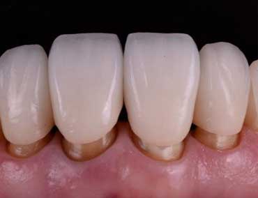 Coroa de Porcelana - Odontologia Curitiba