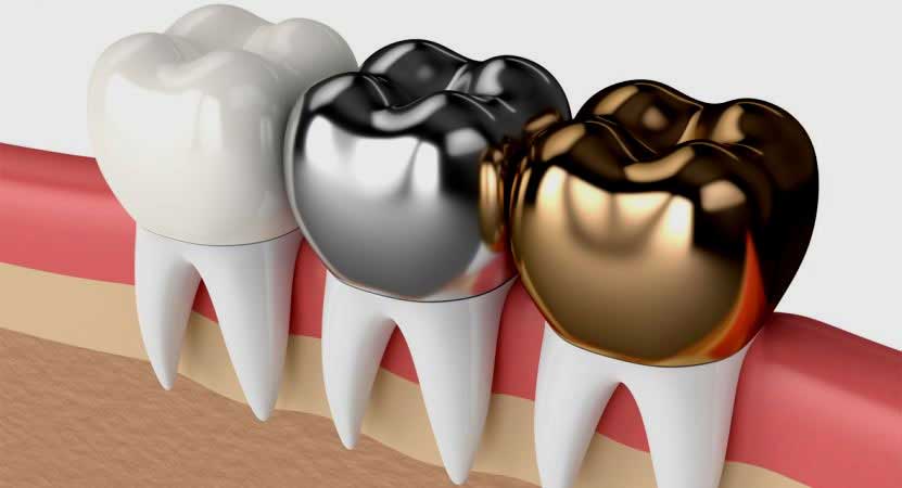 Coroa dentária em Curitiba - Odontologia Curitiba