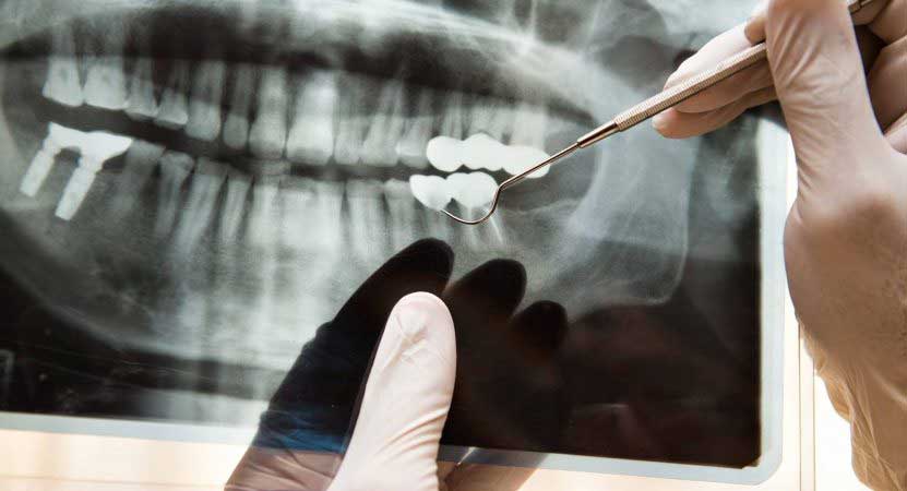 Enxerto ósseo em Curitiba - Odontologia Curitiba