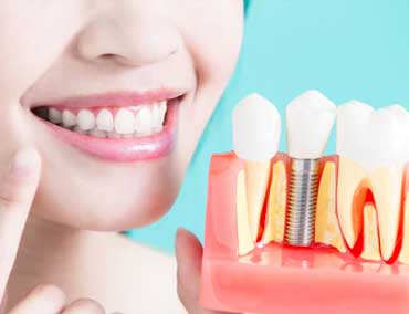 Implante de dentes em Curitiba - Odontologia Curitiba