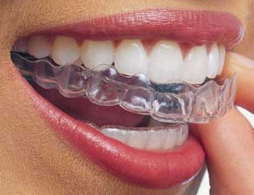 Invisalign, a Evolução da Ortodontia - Odontologia Curitiba