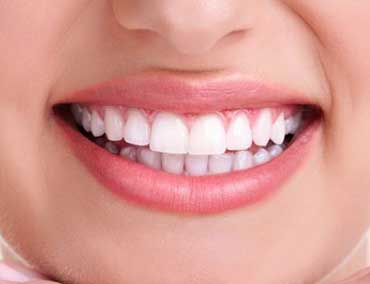 Lentes de contato para os dentes - Odontologia Curitiba