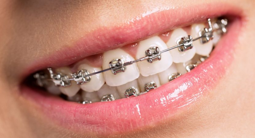 Ortodontia em Curitiba - Odontologia Curitiba