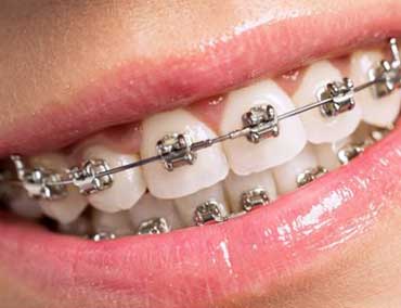 Ortodondia, corrige as posições dos dentes - Odontologia Curitiba