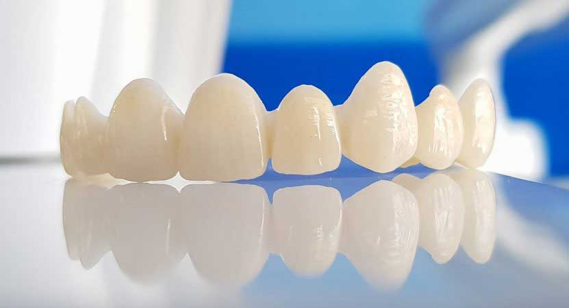 Prótese dentária com zircônia em Curitiba - Odontologia Curitiba