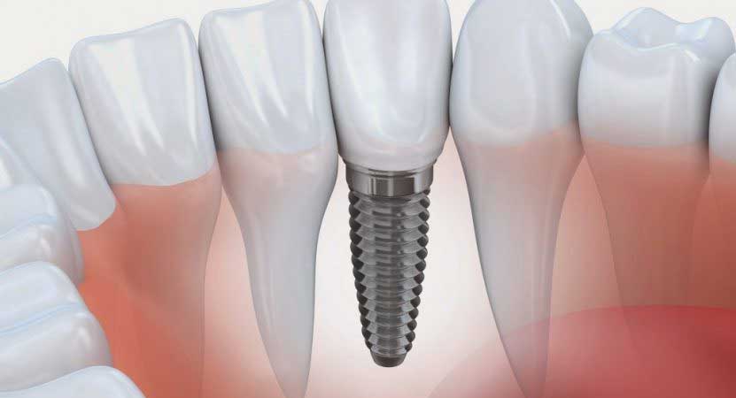 Próteses sobre implantes em Curitiba - Odontologia Curitiba
